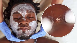 SATISFYING INGROWN HAIR  Beard Care [upl. by Clifton160]