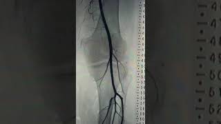 Arteries trifurcation at the knee joint  PrePodiatryClinic101 [upl. by Arykahs231]