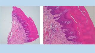 Lecture156 Congenital Naevi and other developmental abnormalities Rooks Chapter 75 [upl. by Teillo]