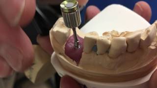 Neodent implant placed on an angle NeoDent tryin abutment kit 17 degree angulated abutment [upl. by Silvia]