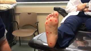 Neurologic Examination of the Foot 10gm Monofilament Test [upl. by Bullard]