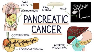 Understanding Pancreatic Cancer [upl. by Oyr185]