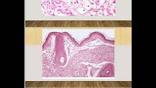 Lid Tumor quotClinical Partquot  Ophthalmology Lecture for fellowship [upl. by Notsob]