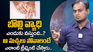 Vitiligo Symptoms Causes Treatment in Telugu  Dr Bharadwaz About Vitiligo  iDream Health [upl. by Haridan]