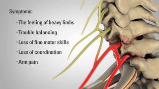 Cervical Laminectomy  Patient Education [upl. by Hermy405]