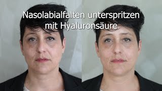 Nasolabialfalten unterspritzen mit Hyaluronsäure [upl. by Notsek]