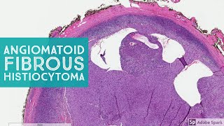 Angiomatoid Fibrous Histiocytoma 101 Note its NOT aneurysmal dermatofibroma [upl. by Ynohtnad470]