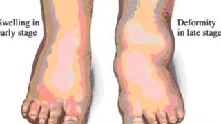 Charcot Foot Awareness [upl. by Cassilda]