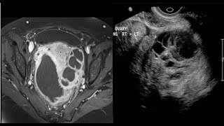 15casepelvicGUgenitourinaryfemaleimagingRenalbladderUSCTMRIRadiologyradiopediafrcrtip [upl. by Aglo]