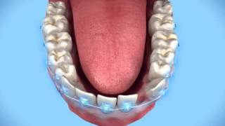 Orthodontics  Single Lower Incisor Extraction [upl. by Amled365]