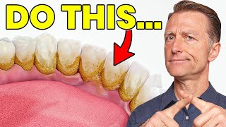 The 1 Top Remedy for Dental Plaque TARTAR [upl. by Solitta313]