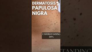 Understanding Dermatosis Papulosa Nigra [upl. by Mozes]