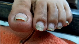 Satisfying Ingrown Toenail Removal  Dry Skin  Pedicure 143 [upl. by Adirehs]