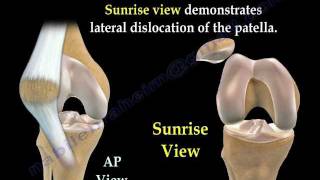 Patellar Dislocations  Everything You Need To Know  Dr Nabil Ebraheim [upl. by Aryan40]