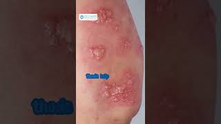 What is Herpes  Skin viral infection  Herpes simplex virus HSV  dermatologist [upl. by Butterworth]