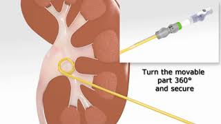 Nephrostomy Magnusson Locking System by UROTECH [upl. by Hpeosj139]