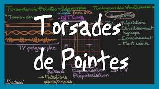 Torsades de pointes ECG symptômes causes et traitement [upl. by Amick]