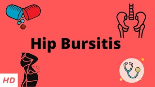 Hip Bursitis Causes Signs and Symptoms Diagnosis and Treatment [upl. by Nihi979]