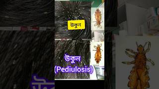 Pediulosis উকুন [upl. by Aihsram]