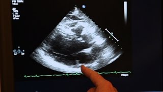 Echocardiogram Demonstration [upl. by Anitsuj663]