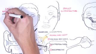 Acute Otitis Media Causes Pathophysiology signs and symptoms treatment and complications [upl. by Brotherson402]