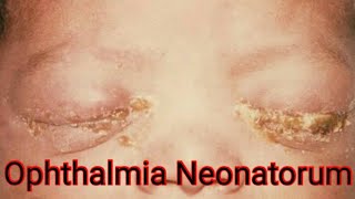 Ophthalmia Neonatorum Neonatal Conjunctivitis causes Treatment [upl. by Bouzoun986]