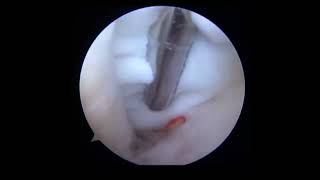 Arthroscopic Excision of a Deep Infrapatellar Cyst [upl. by Ahsyad856]