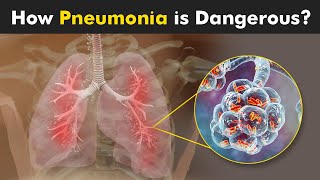 What Happens in Pneumonia  Symptoms Causes and Treatment 3D Animattion [upl. by Olshausen432]