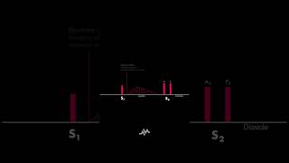 Pulmonic Stenosis [upl. by Alben]