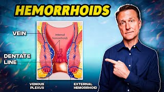 The 1 Best Remedy for Hemorrhoids  Dr Berg [upl. by Nylqcaj]