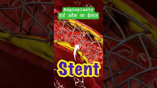 Angioplasty angioplasty heartattack facts ytshortsindia science [upl. by Rubel907]