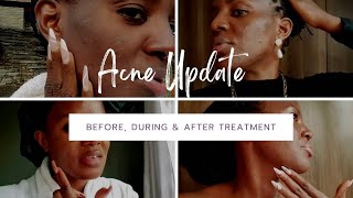 VLOG MY FULL ACNE JOURNEY  Recovery With Clabane Skin Care [upl. by Fredrika]