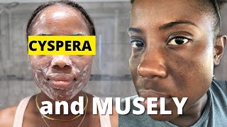 My Skincare Routine using Cyspera Cysteamine and The Musely Spot Cream [upl. by Aleksandr]