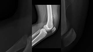 Pedunculated osteochondroma shoets [upl. by Anatlus]