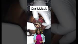 Worms in patient’s mouth  oral Myiasis dentist wormszone worms scary oralhealth [upl. by Lemieux]