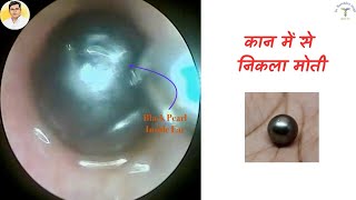 Black Pearl Inside Ear  कान में से निकला मोती  NEETPG 2024 [upl. by Sharl]