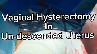 Vaginal Hysterectomy in Undescended uterus  Very important  Tips and Tricks  to make it Easy ⭐️⭐️ [upl. by Dripps305]