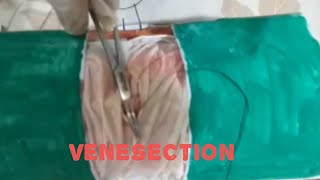 Venesection basic surgical procedure Theraputic thrombectomy Emergency procedure [upl. by Yesak758]