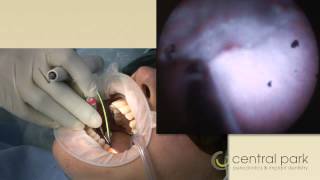 CPPI  Perioscopy Video [upl. by Cleres]