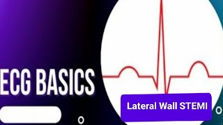 ECG Basics  Lateral Wall STEMI [upl. by Isac]