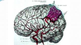 NEUROLOGIE HÉMORRAGIE MÉNINGÉE 2015 [upl. by Baily]