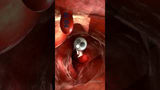 ENDOSCOPIC PROCEDURE  Endoscopic view of our Intestine 🧑‍⚕️healthfield medicineknowledge [upl. by Fidel572]