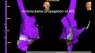 Atrial Flutter  Cavo tricuspid isthmus conduction and block [upl. by Keare843]