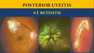 POSTERIOR UVEITIS  retinitis vs choroiditis [upl. by Eerdna]