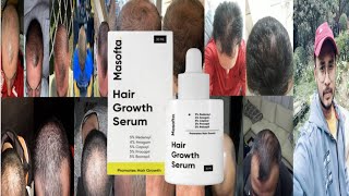 Masofta Hair Growth Serum  Honest Review [upl. by Iridissa355]