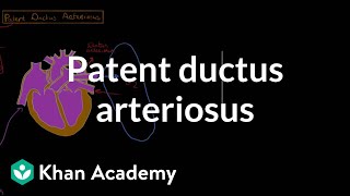 Patent ductus arteriosus  Circulatory System and Disease  NCLEXRN  Khan Academy [upl. by Odawa852]