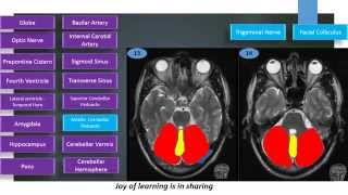 MRI Brain Sectional Anatomy Cut 13 amp 14 [upl. by Oirasec]