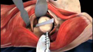 Femoral Head Osteotomy Animation  Direct Anterior Total Hip Replacement [upl. by Hsemin472]