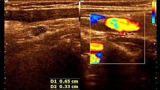 Neck Mass  Cervical Lymph node  Cervical Lymphadenopathy  Neck Ultrasonography [upl. by Sibyls]