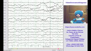 Demostración de un VideoElectroencefalograma [upl. by Kidd]